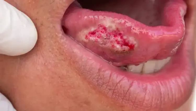 Migren Şikayetiyle Giden Kadında Kanser Tehlikesi: Dikkat Edilmesi Gereken 4 Belirti