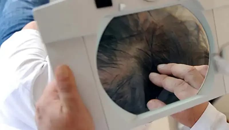 İstanbul'daki Saç Ekimi Sonrası Ani Ölüm Olayı Şok Etkisi Yarattı