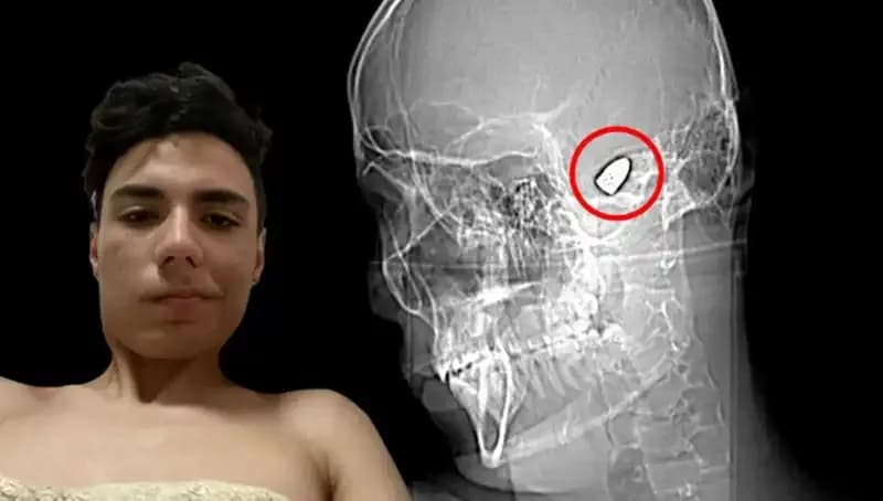 Kafasında Patlamaya Hazır Bomba Taşıyan Adamın Hikayesi