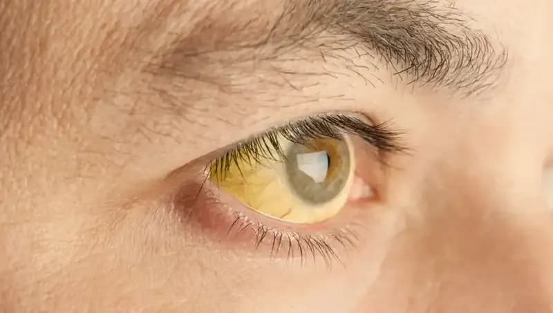 Gözlerinizdeki Değişiklikler, Karaciğer Sağlığınız Hakkında Ne Söylüyor?